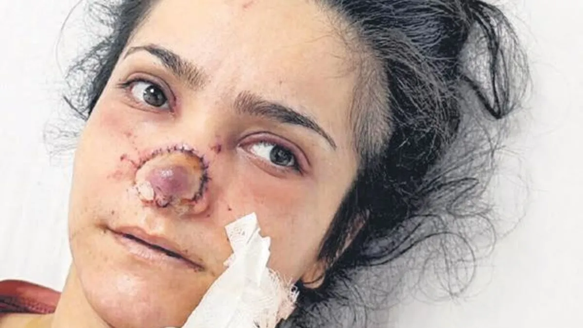 Kocası ısırarak koparmıştı, burnu ameliyatla dikildi